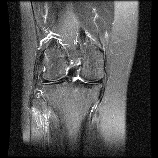 Coronal magnetic resonance image slice 14 of 28